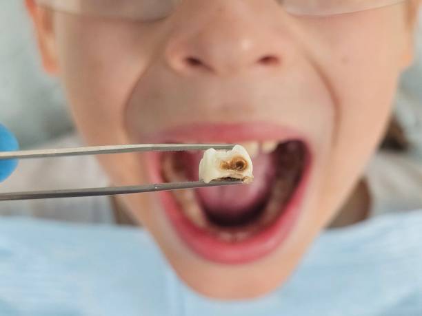 Best Broken or Cracked Tooth Emergency Dentist in North Bellmore, NY